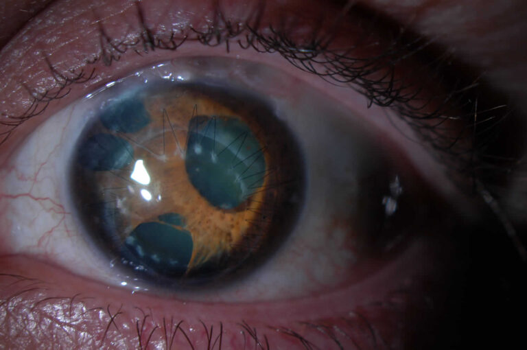 Iridocorneal endothelial syndrome, causes, symptoms, diagnosis