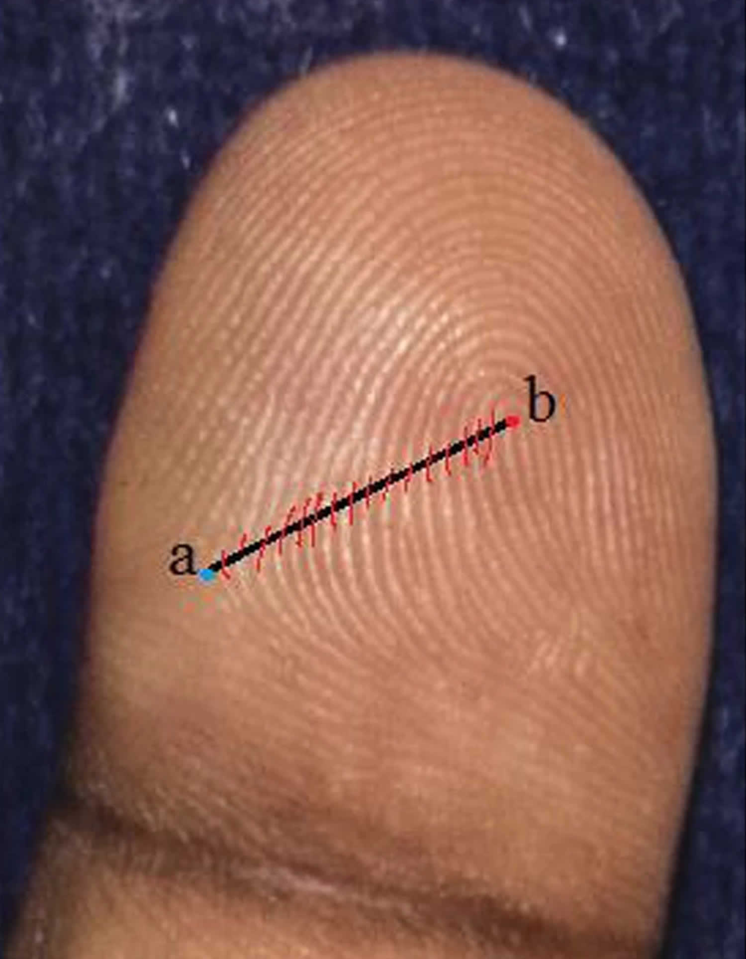 Dermatoglyphics Definition Uses Causes Of Abnormal Dermatoglyphics