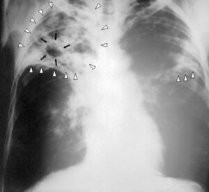 Ghon complex, ghon focus, definition, chest x-ray & causes