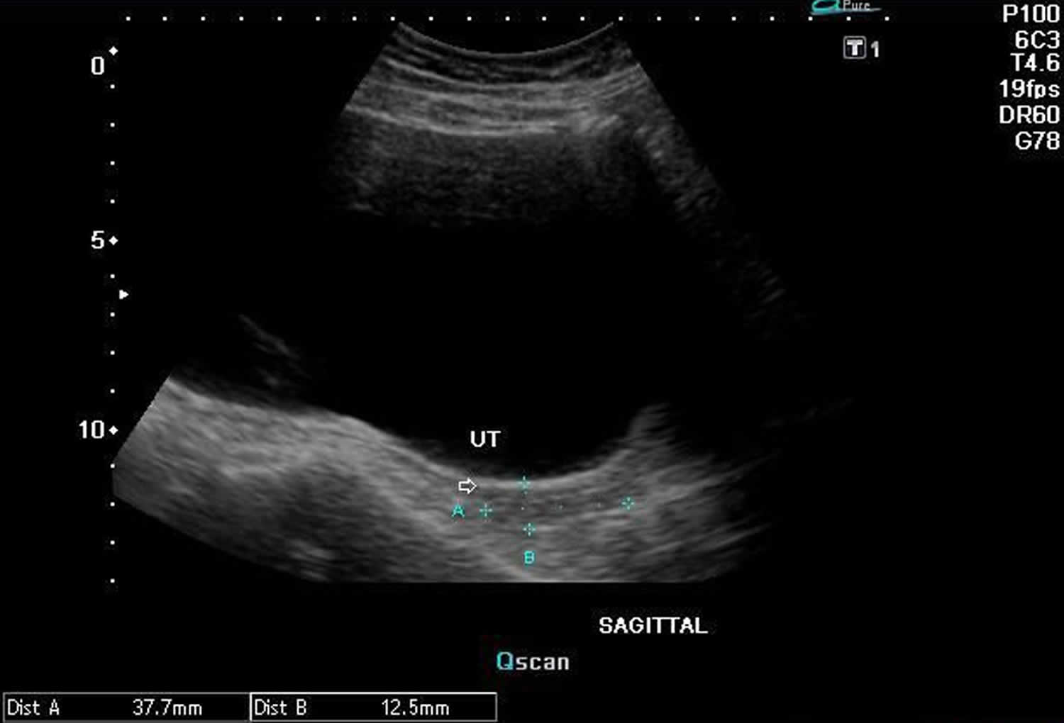 Hypoplastic uterus ultrasound