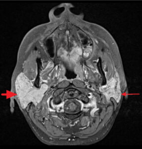 Mikulicz Syndrome Definition, Causes, Symptoms, Diagnosis, Treatment ...