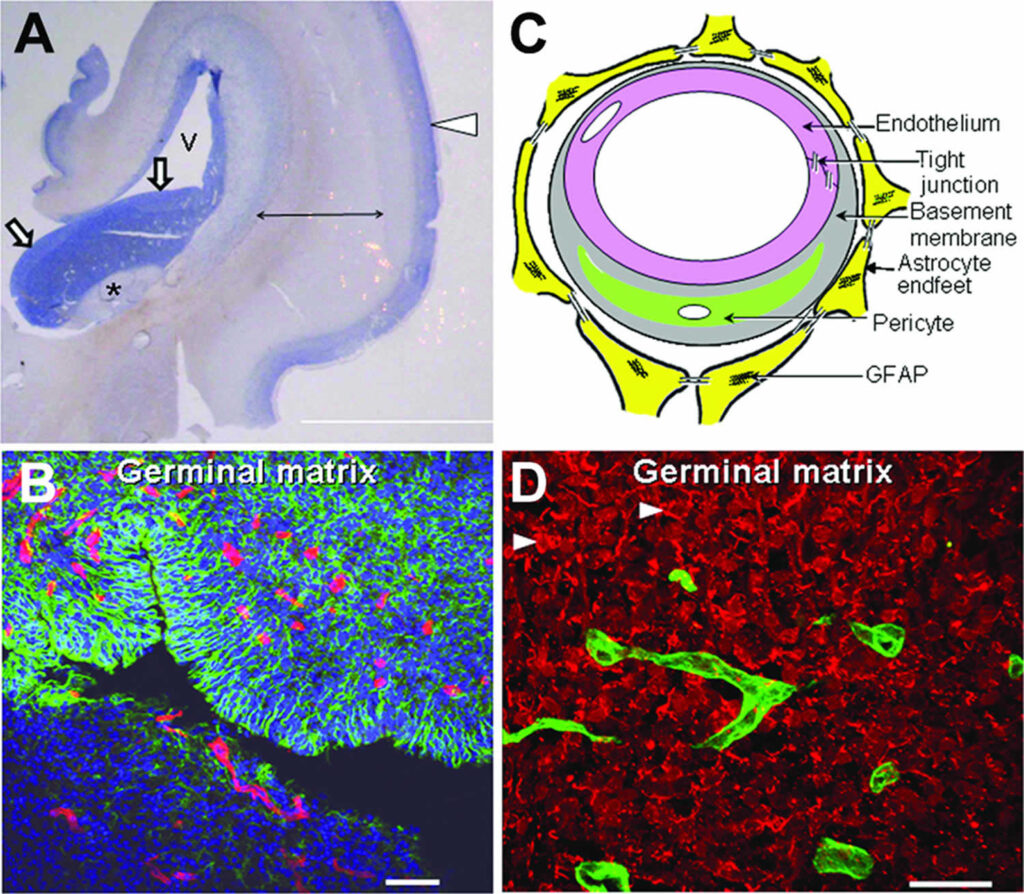 Germinal Matrix Hemorrhage Causes Symptoms Diagnosis Treatment