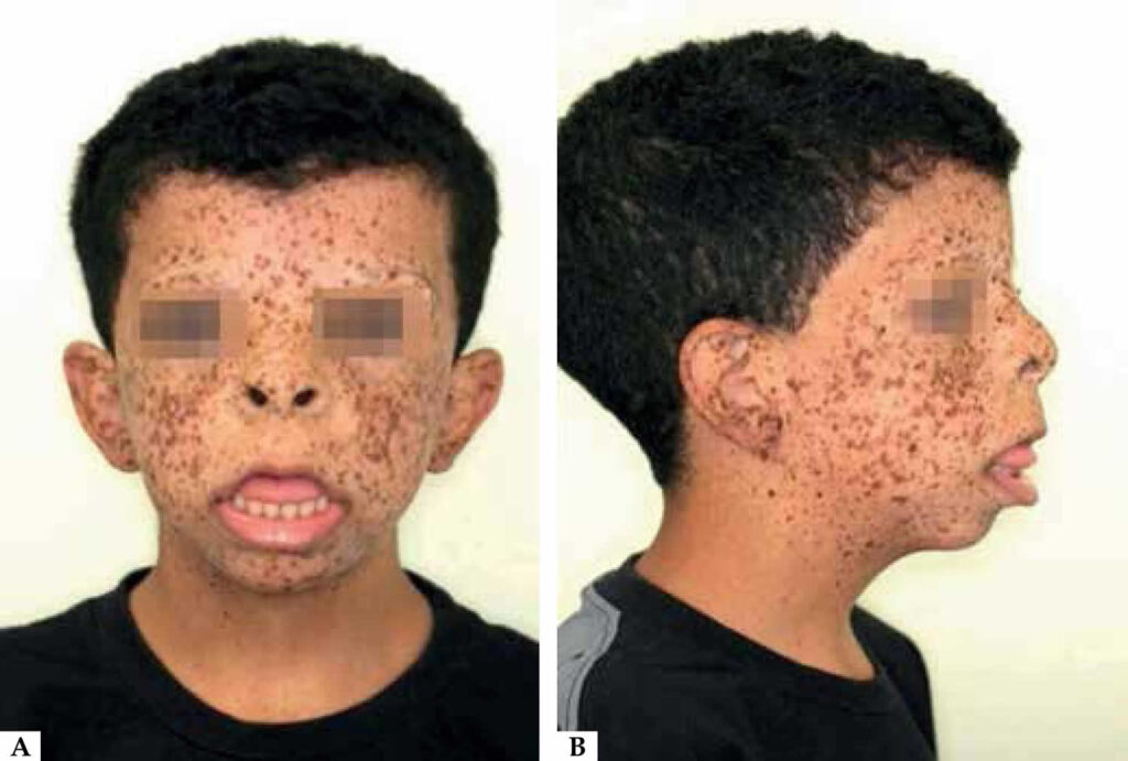 Rasopathy, genes, causes, signs, symptoms, diagnosis & treatment