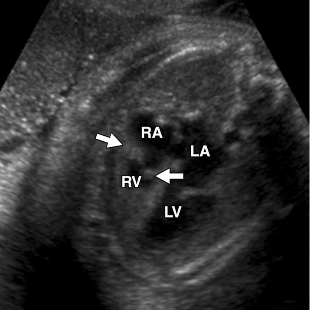 Hypoplastic right heart syndrome causes, symptoms, diagnosis, treatment ...