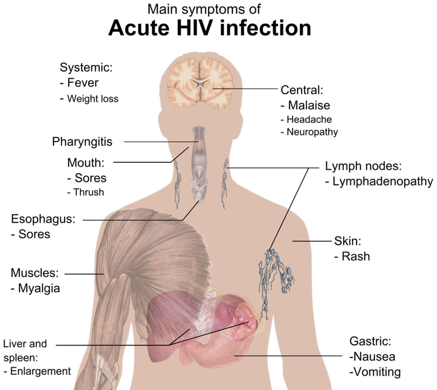 Acute retroviral syndrome causes, symptoms, diagnosis & treatment