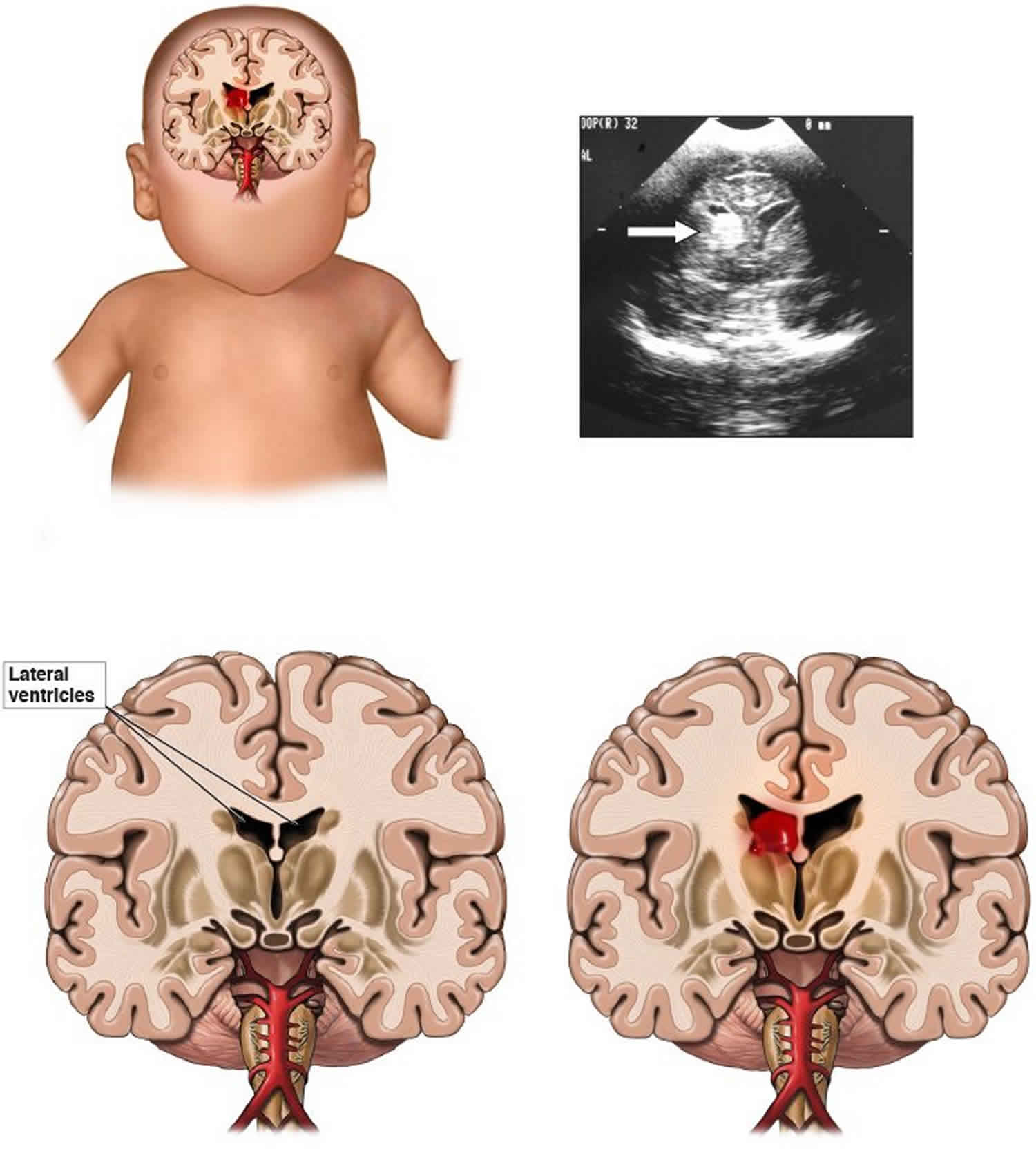 Germinal Matrix Hemorrhage Causes Symptoms Diagnosis Treatment 