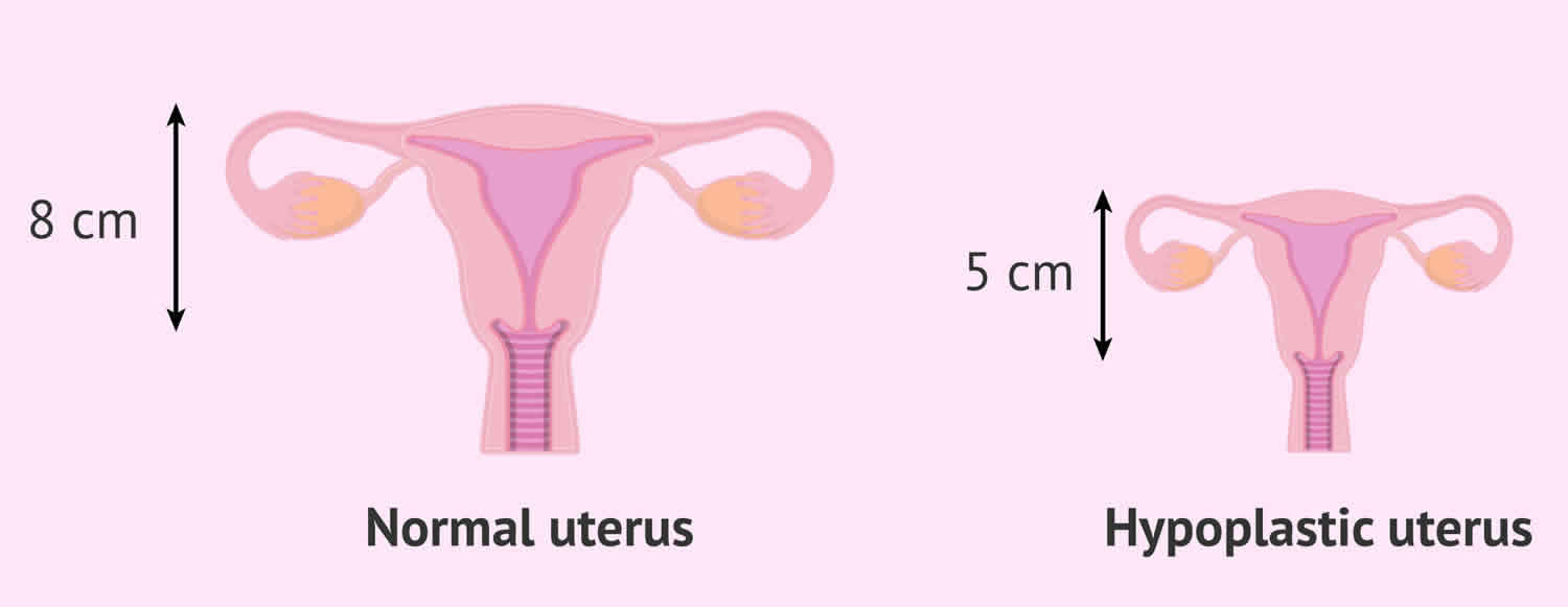 hypoplastic uterus
