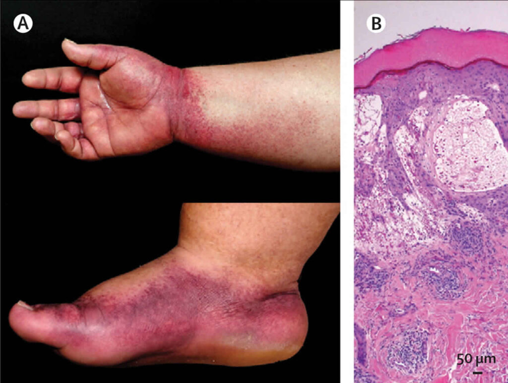 Papular purpuric gloves and socks syndrome, causes