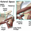quadrilateral space syndrome