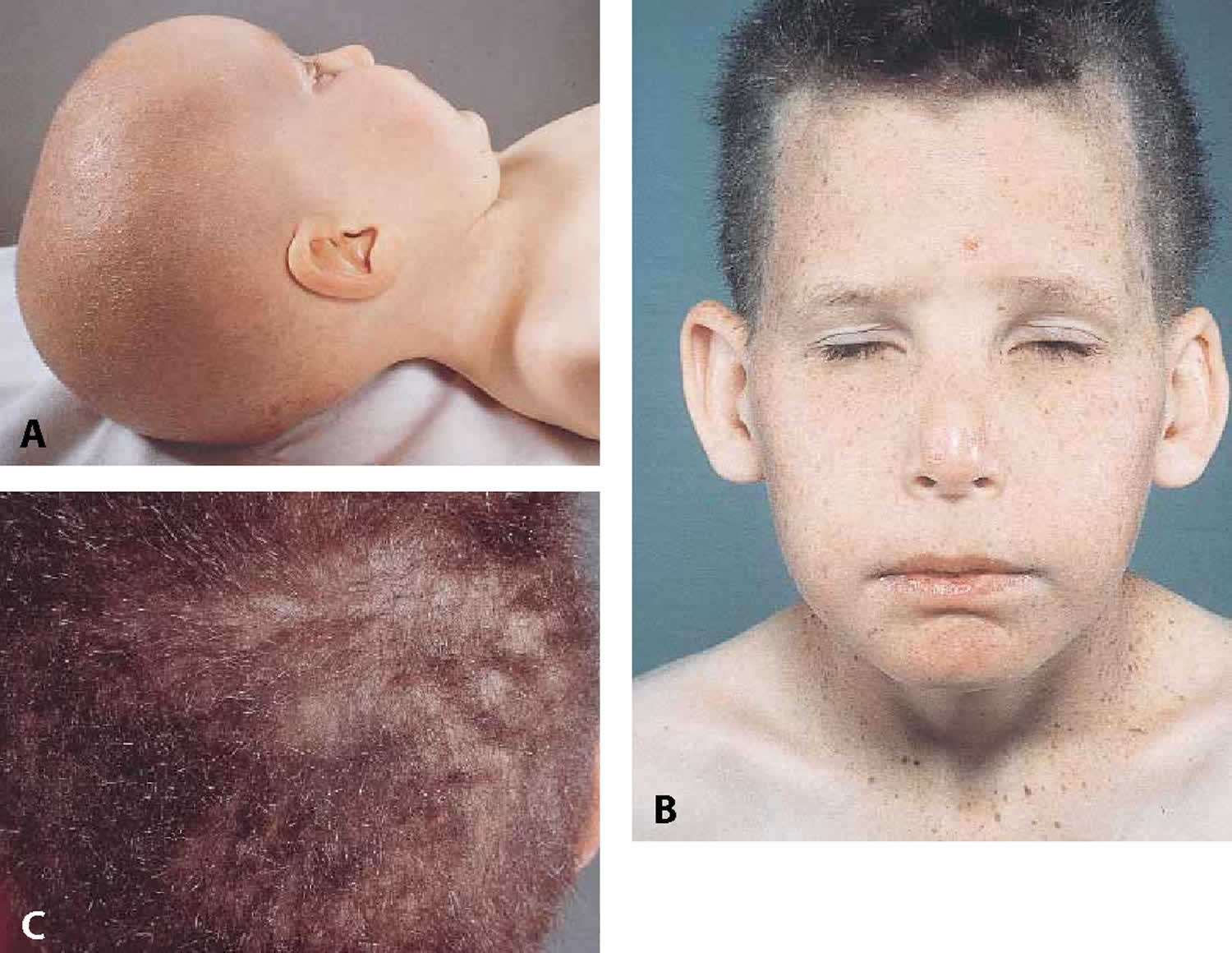 trichothiodystrophy syndrome