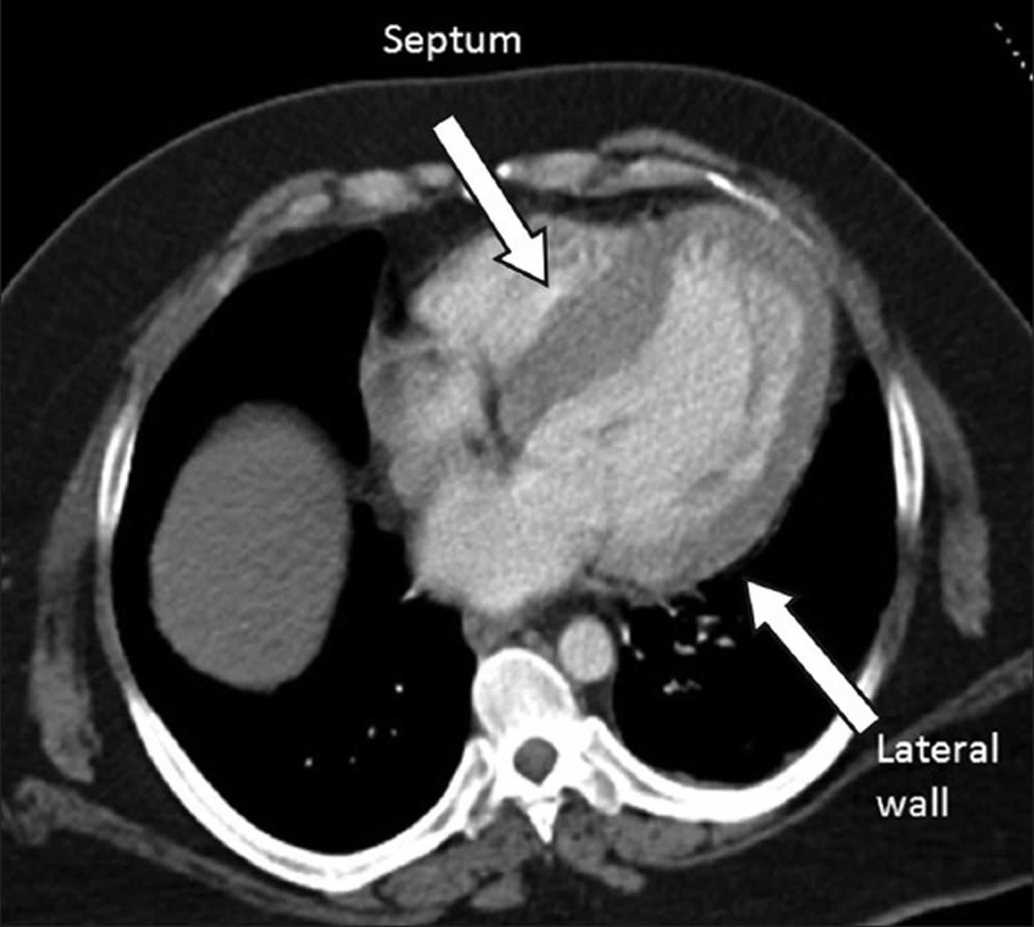 asymmetric-septal-hypertrophy-definition-causes-symptoms-diagnosis