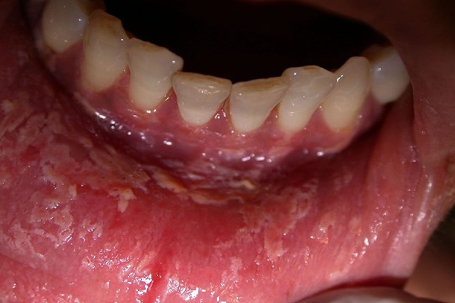 舌の口内炎の種類別・症状や原因、治し方を紹介!口内炎と間違えやすい病気も