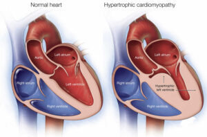 Asymmetric septal hypertrophy, definition, causes, symptoms, diagnosis ...