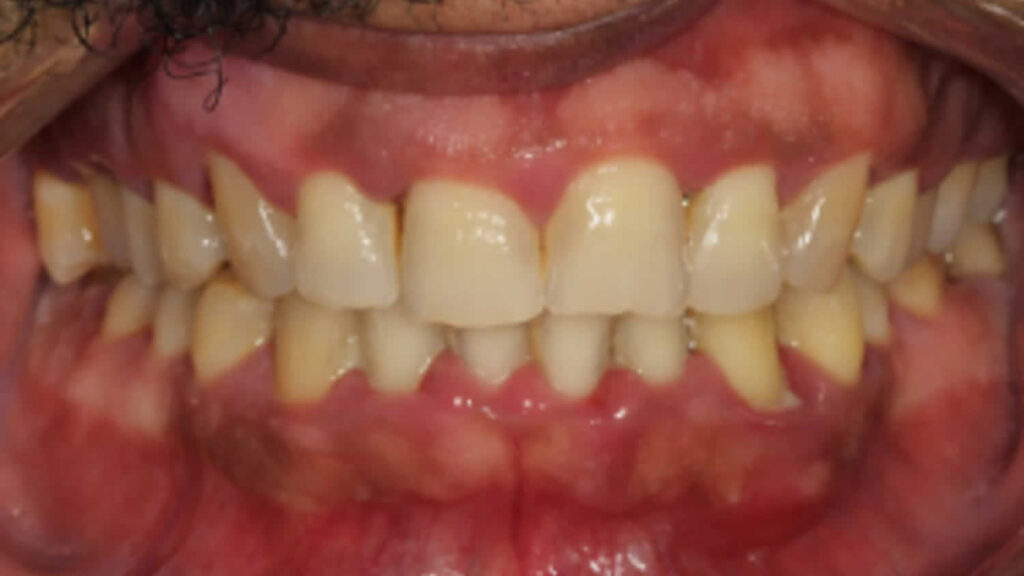 gingival-hypertrophy-causes-symptoms-diagnosis-treatment