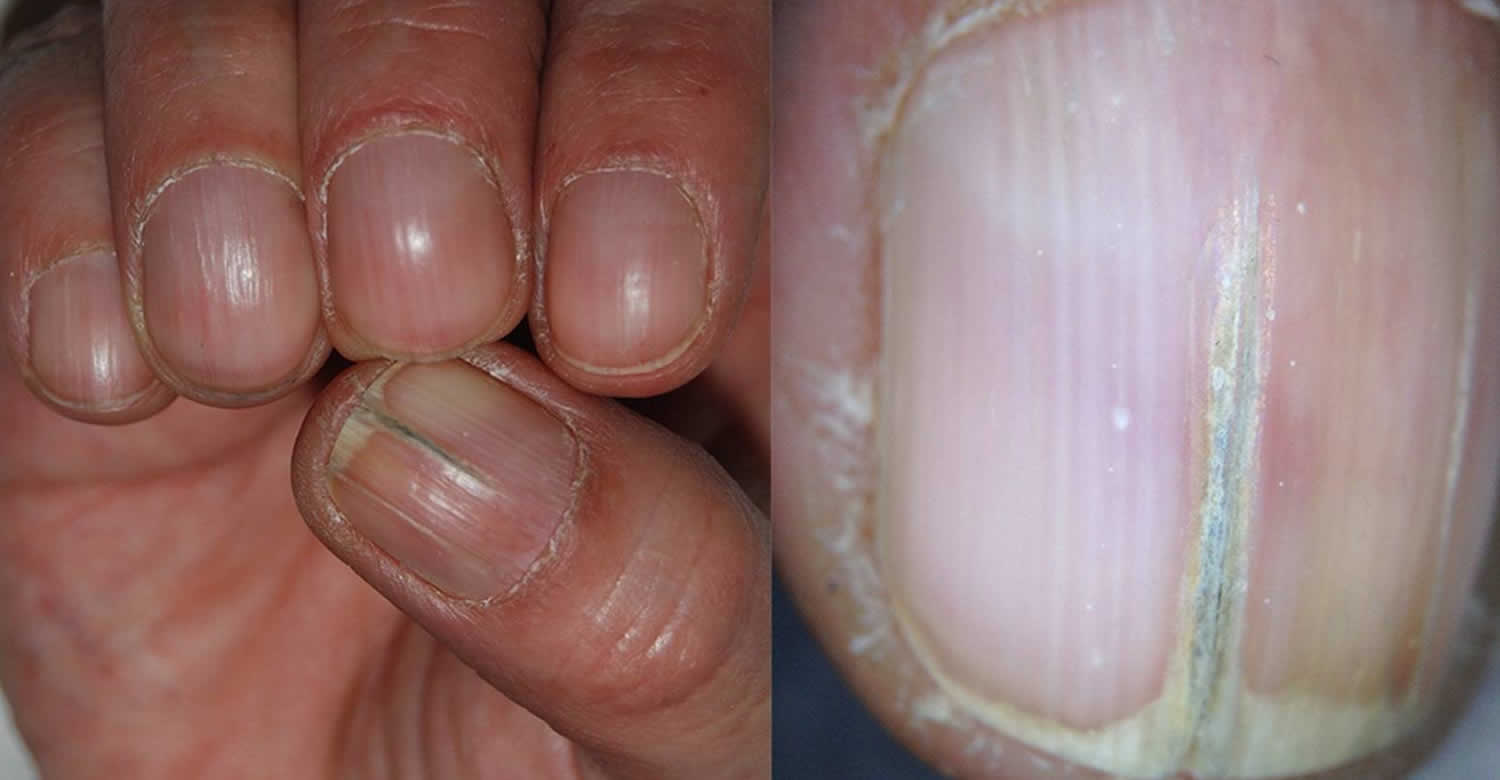 Brittle nails - Iorizzo - 2004 - Journal of Cosmetic Dermatology - Wiley  Online Library