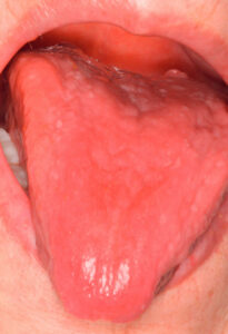 smooth red patch in mouth