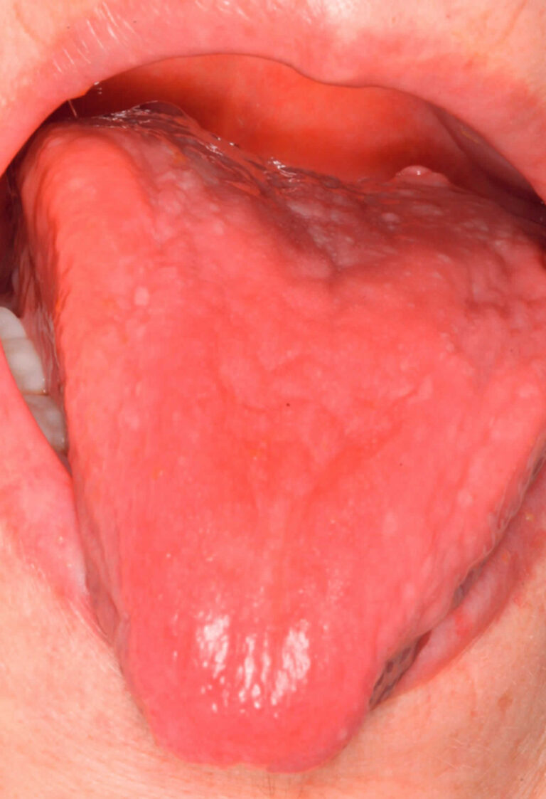 b12 deficiency home treatment