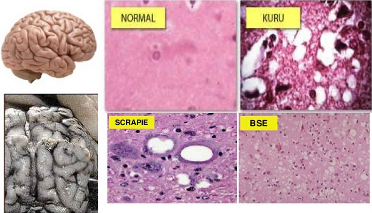 What Causes Mad Cow Disease And Other Such Spongiform Encephalopathies Quizlet