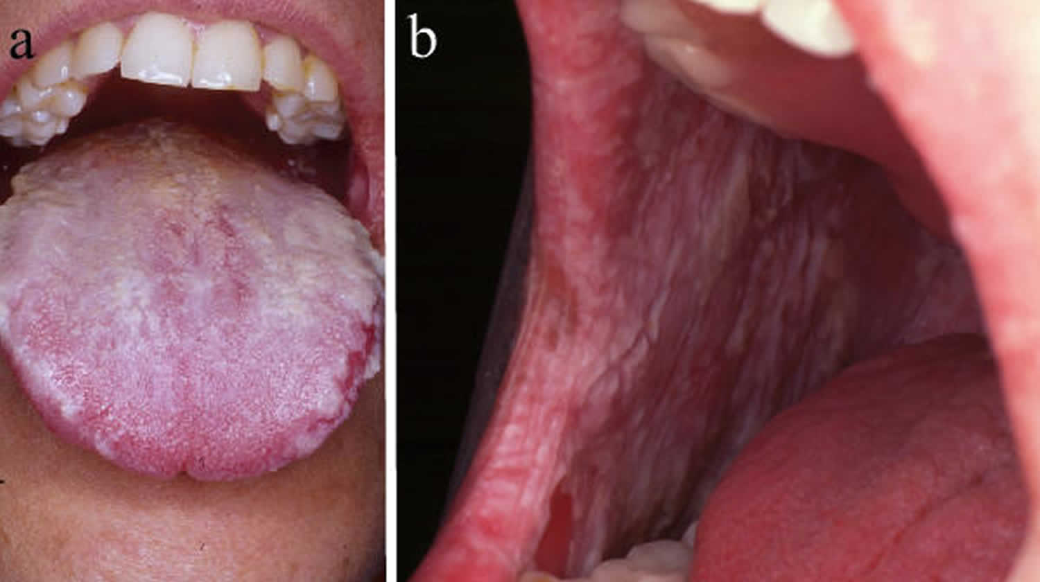 white sponge nevus gingiva