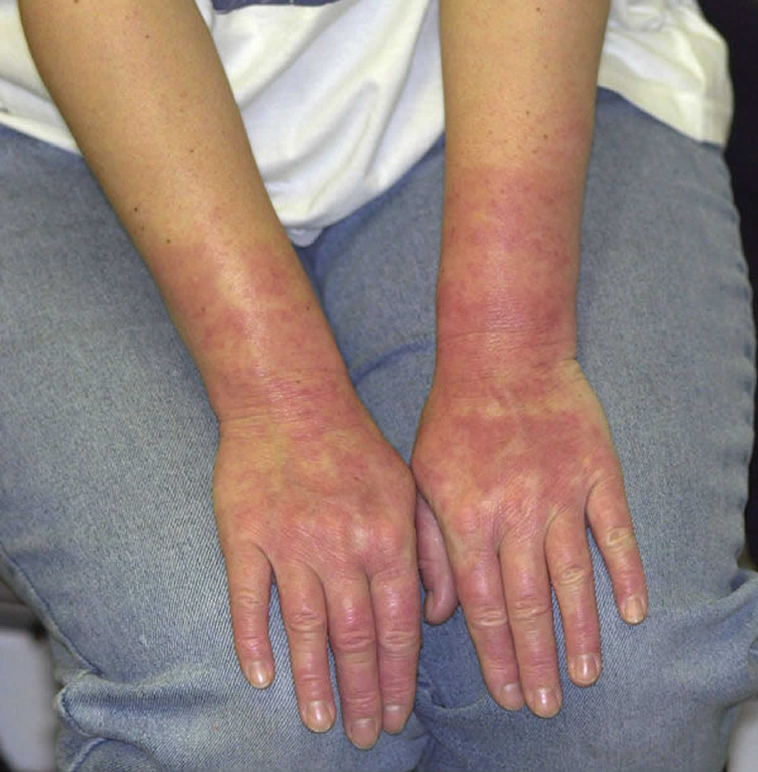 contact-urticaria-definition-causes-symptoms-diagnosis-prognosis