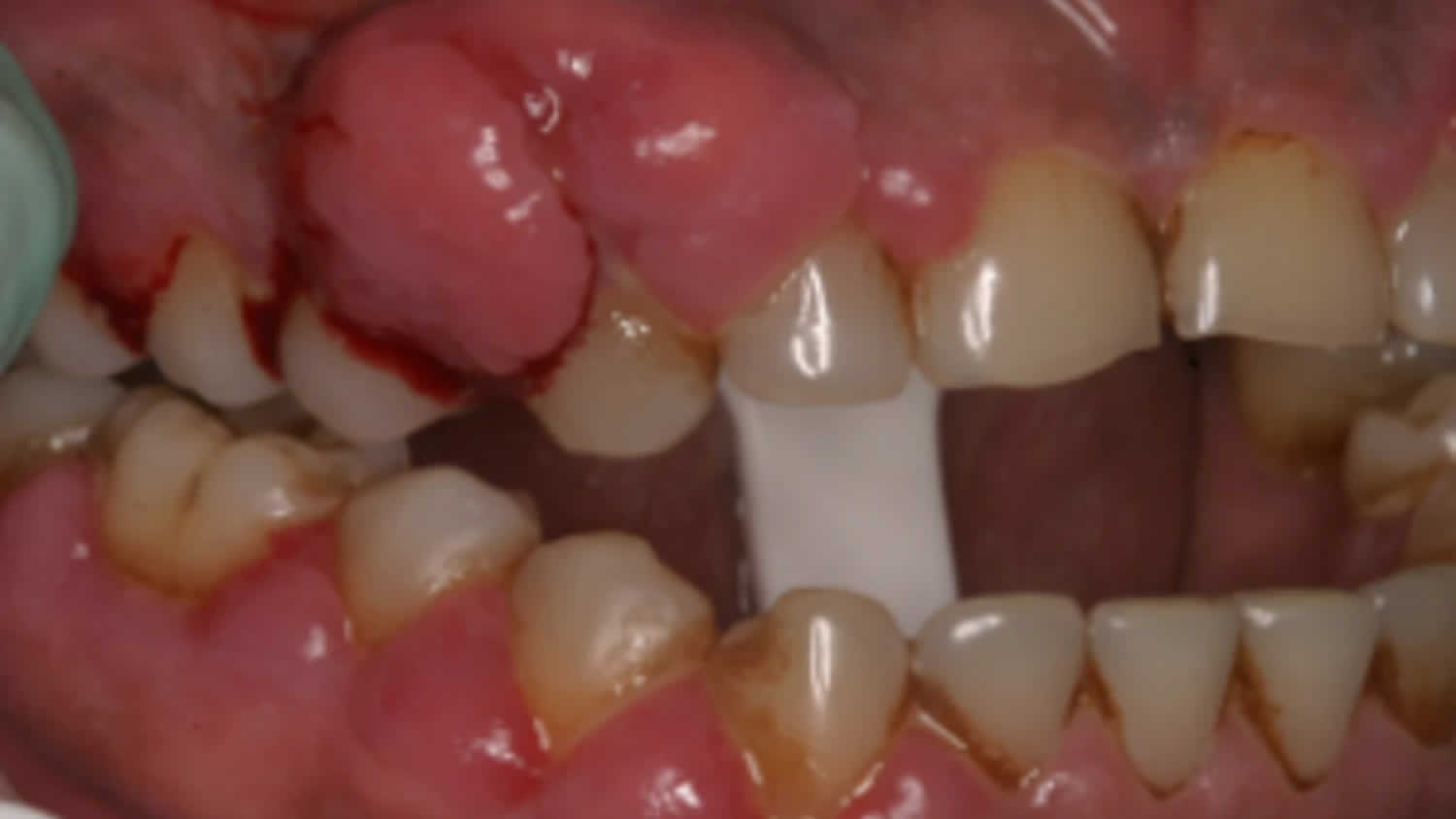 gingival-hypertrophy-causes-symptoms-diagnosis-treatment