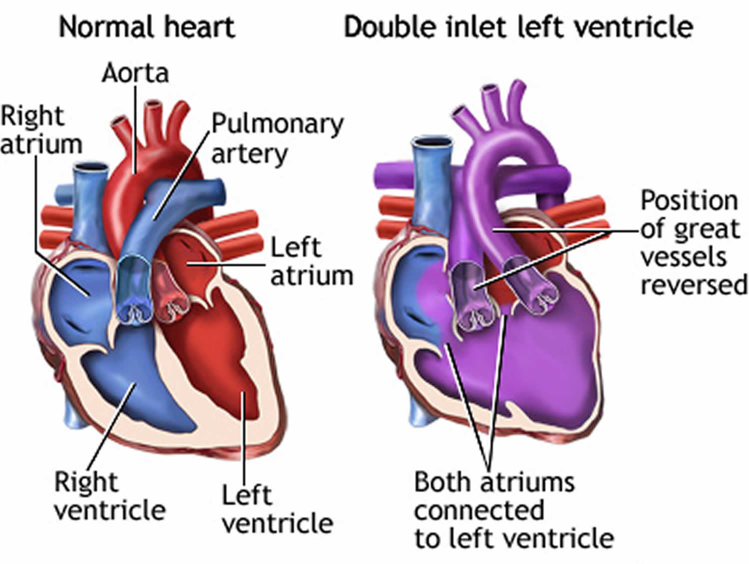 Double inlet left ventricle, causes, symptoms, diagnosis, treatment ...