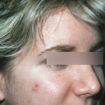 excoriated acne