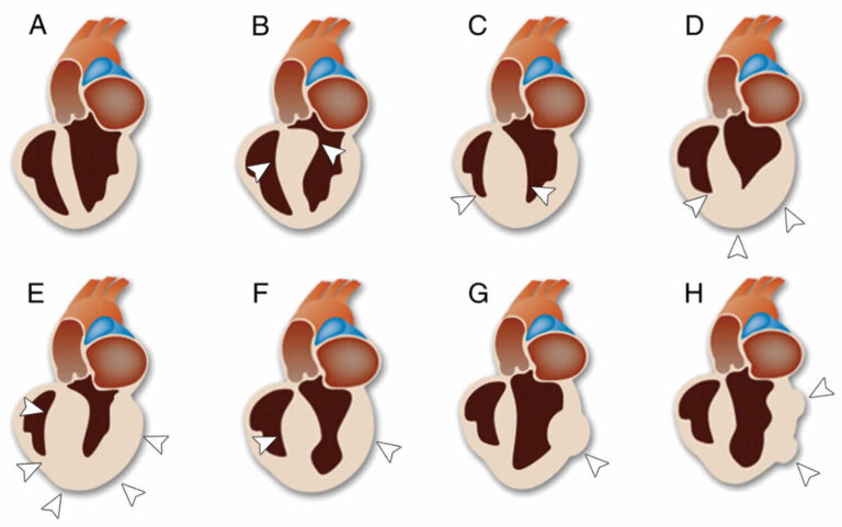 asymmetric-septal-hypertrophy-definition-causes-symptoms-diagnosis