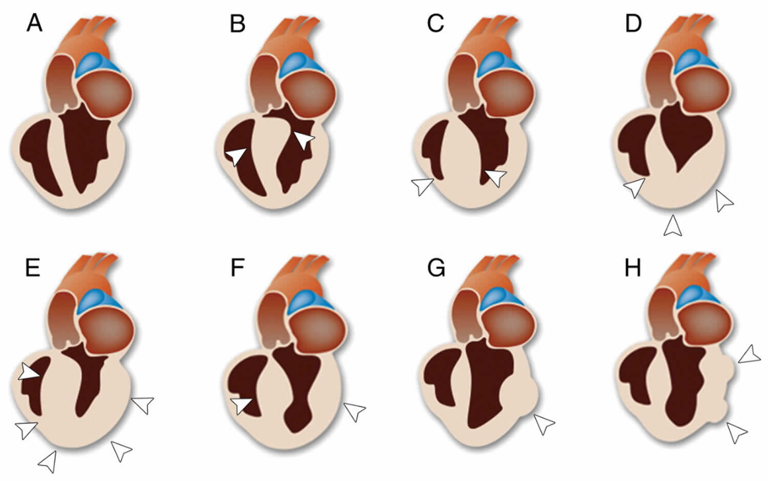 pathological hypertrophy heart diagram