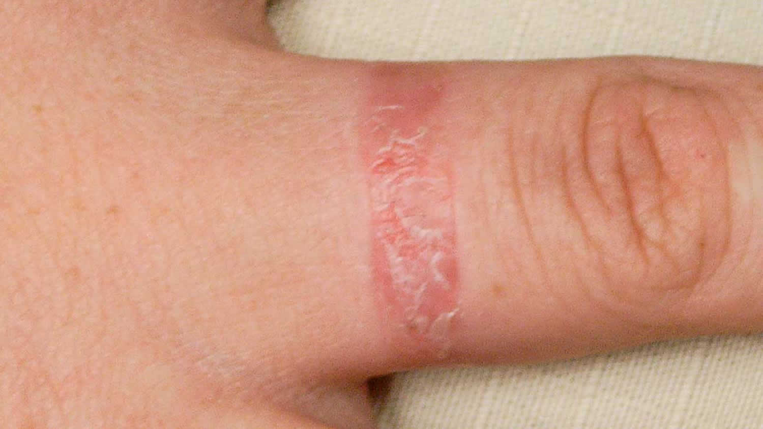 Nickel Allergic Contact Dermatitis Causes Symptoms Diagnosis Treatment