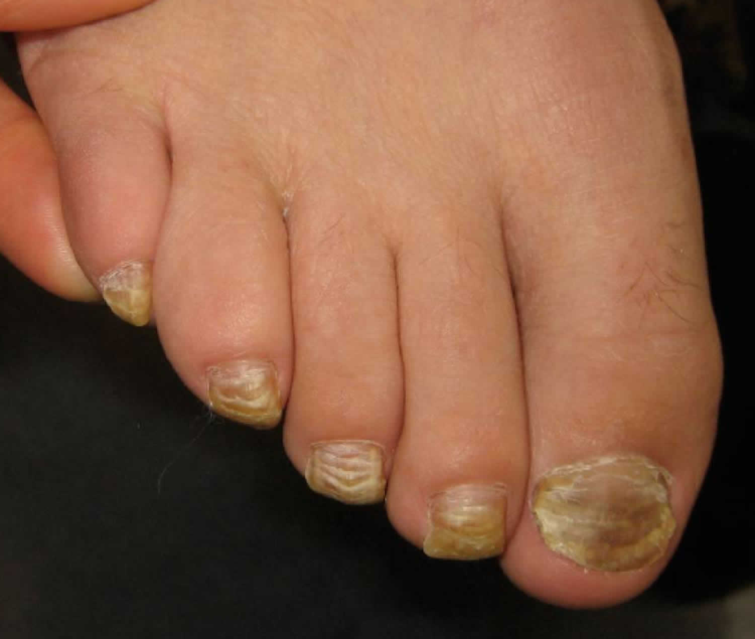 Nail Abnormalities - Part 2 (Koilonychia, Clubbing & Onycholysis) - The Nail  Bar Beauty & Co.