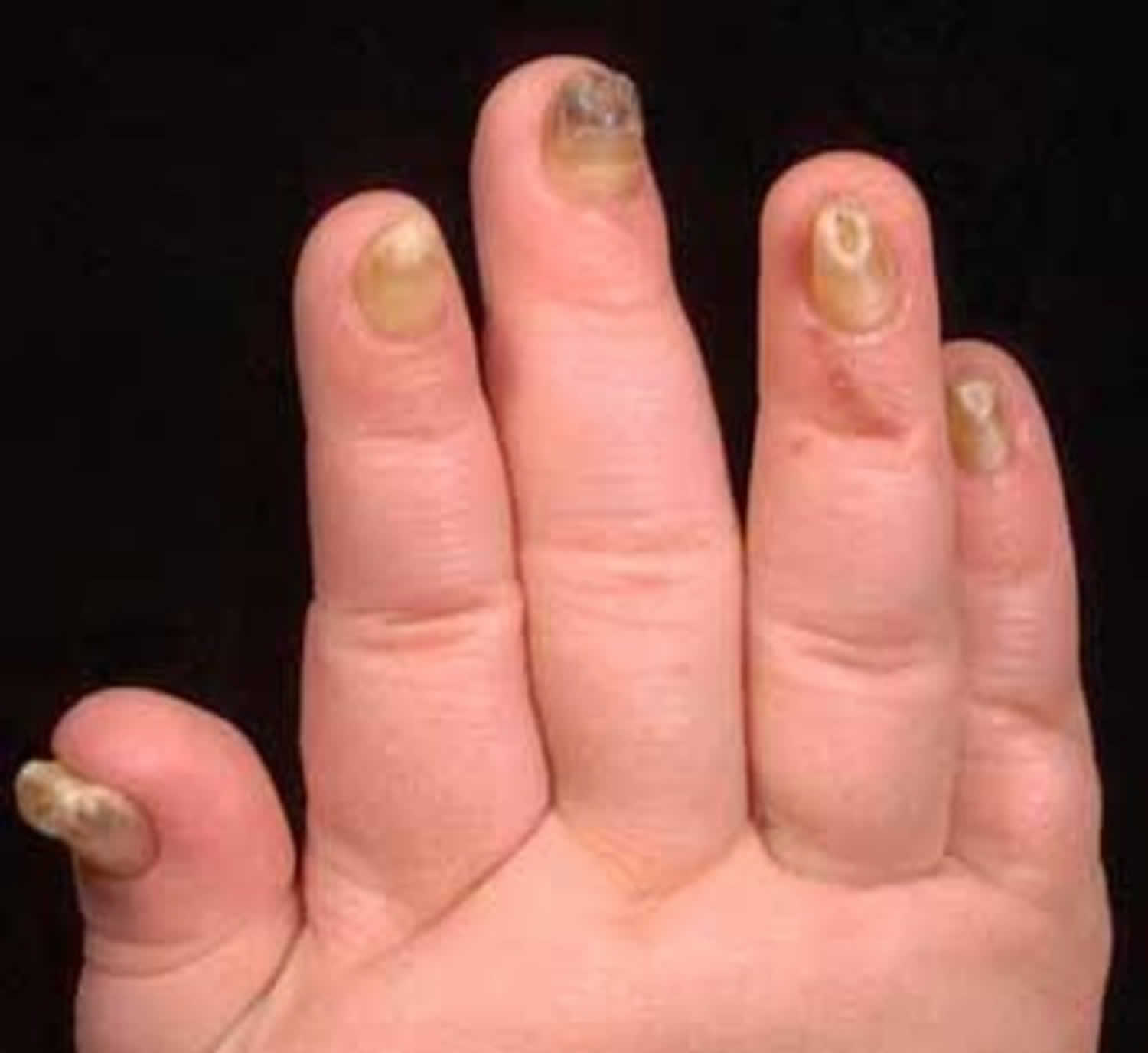 onychauxis nagels