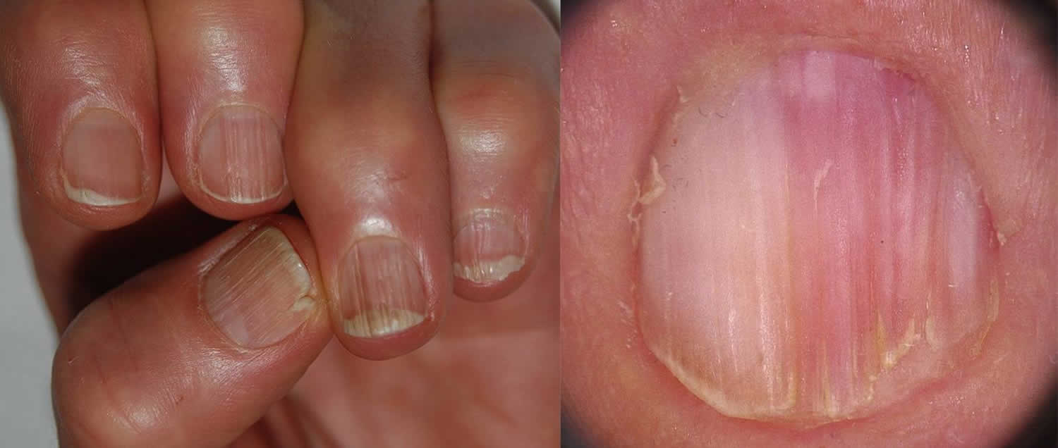 NAILS - THE FIRSTHAND SIGN TO UNDERSTAND THE UNDERLYING DISEASE CONDITION -  homeopathy360