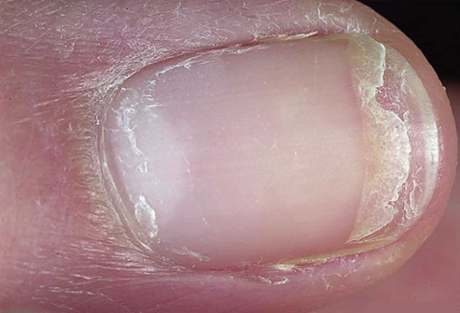 Fungal Nail Infections | Fungal Diseases | CDC