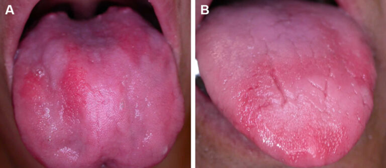 b12 deficiency home treatment
