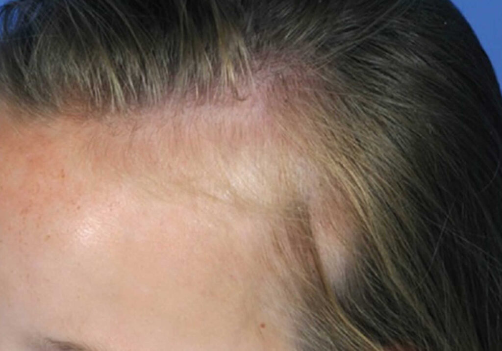 Congenital triangular alopecia, causes, symptoms, diagnosis & treatment