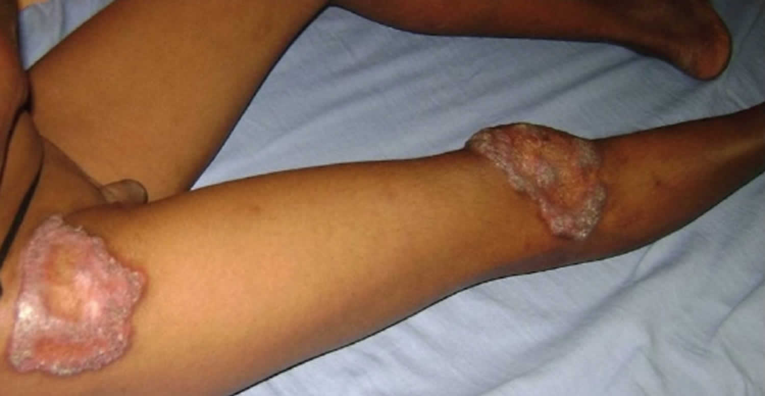 Lupus vulgaris on the leg