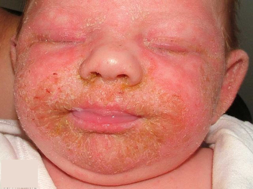 Dermatitis Around Nose Seborrheic At Julie Mccord Blog