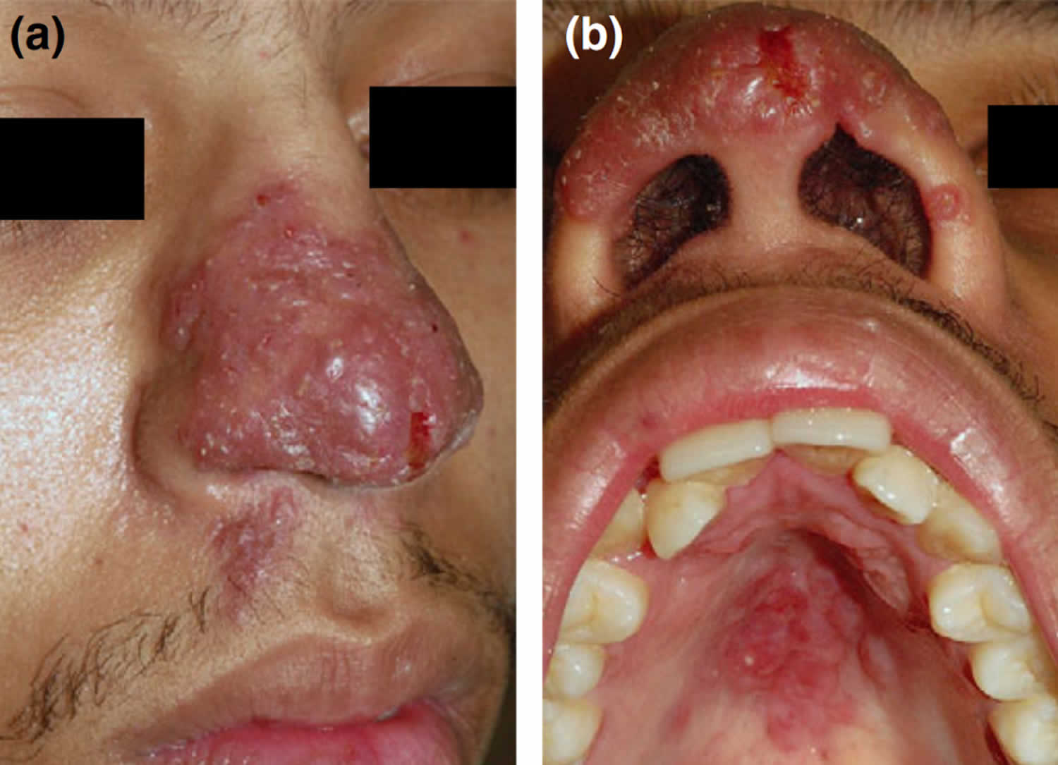 lupus vulgaris nose