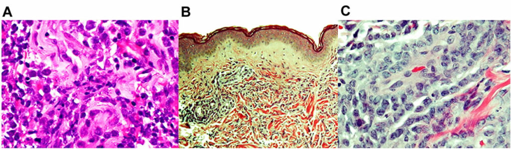 Myeloid Sarcoma Causes Symptoms Diagnosis Treatment And Prognosis