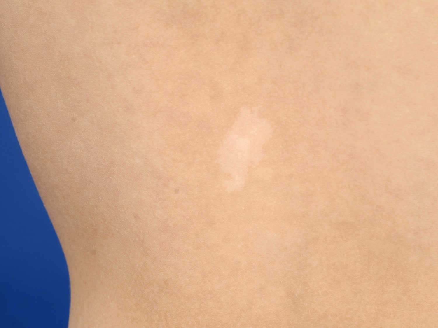 Nevus Depigmentosus Causes Diagnosis And Treatment