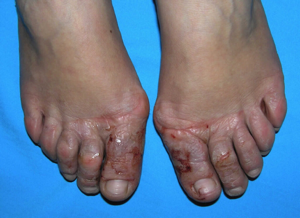 Shoe contact dermatitis, causes, symptoms, diagnosis & treatment