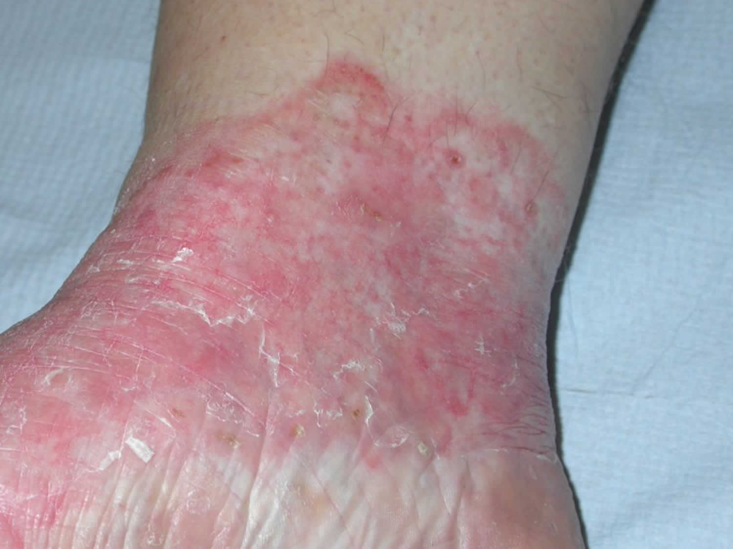 Tinea incognito, causes, symptoms, diagnosis & treatment