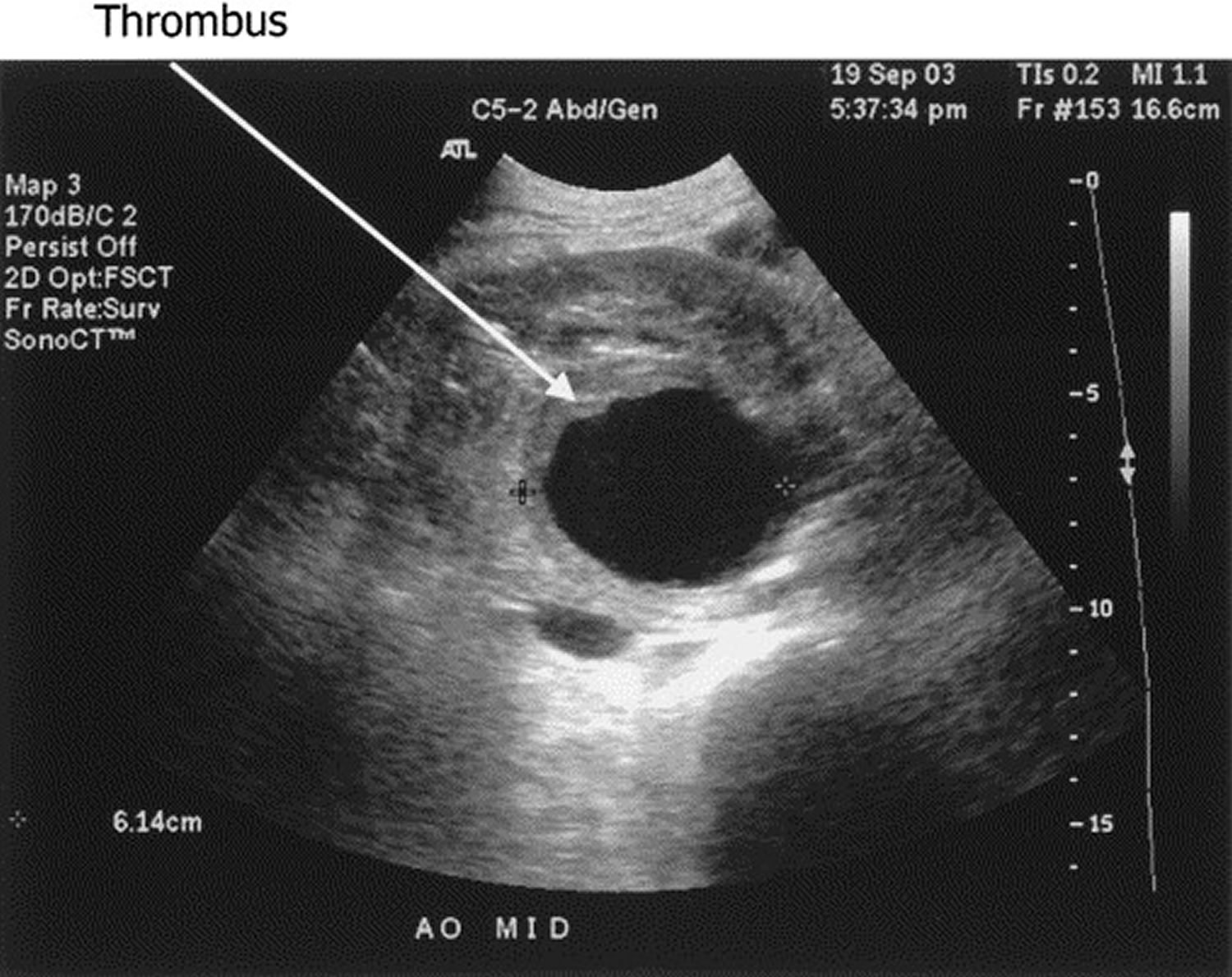 Abdominal aortic aneurysm ultrasound