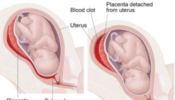 Abruptio placentae