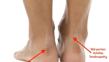 Achilles tendinitis