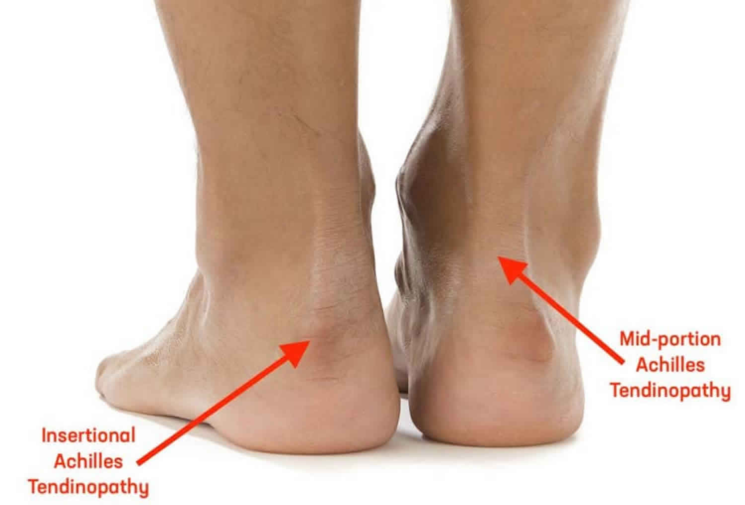 Achilles Tendinitis - Bucks Osteopathy & Physio