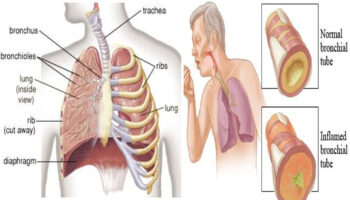 Acute bronchitis