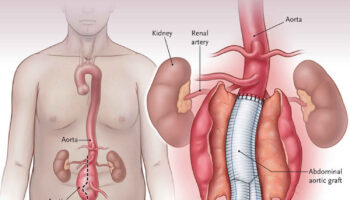 abdominal aortic aneurysm