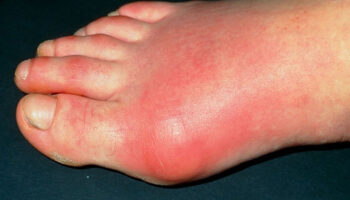 gout